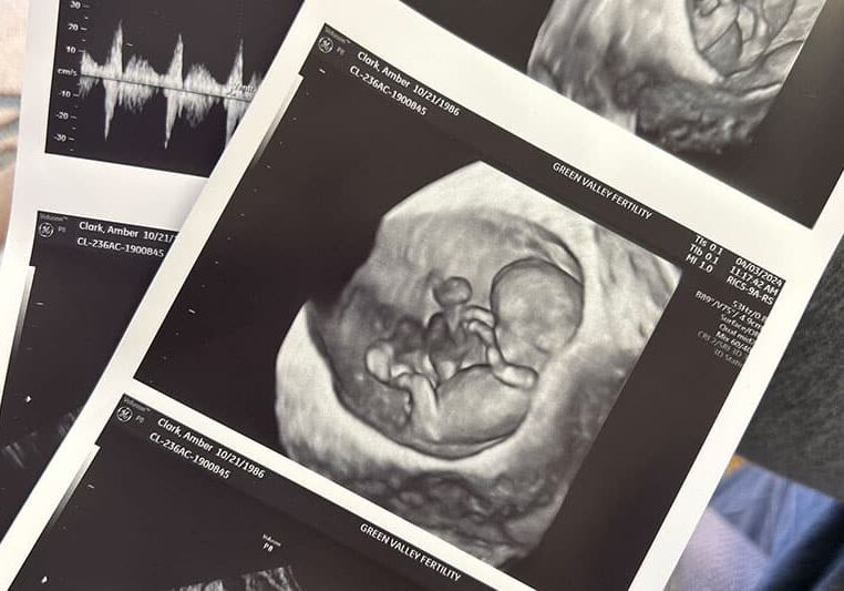 close up of ultrasound pictures after becoming a surrogate